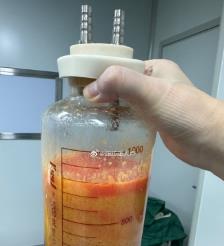 鞍山水动力吸脂手术要做多久？